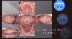 교정 Case 1318. 부분교정, Anterior Space Closing, Sem #20.5