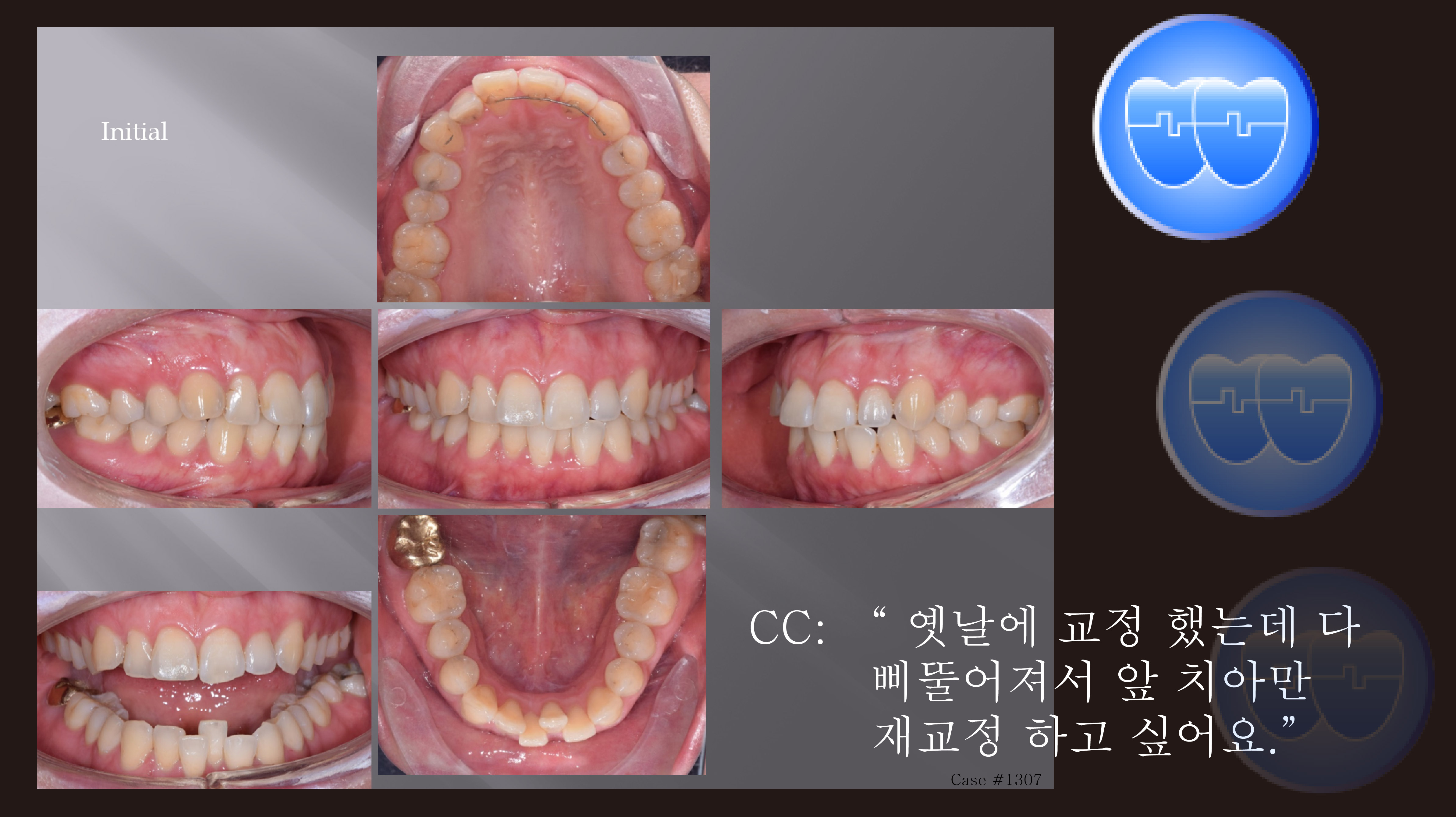 교정 Case 1307. 비발치, 문제환자 대처방법, Gaining Space for Leveling, Sem #3