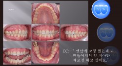 교정 Case 1307. 비발치, 문제환자 대처방법, Gaining Space for Leveling, Sem #3