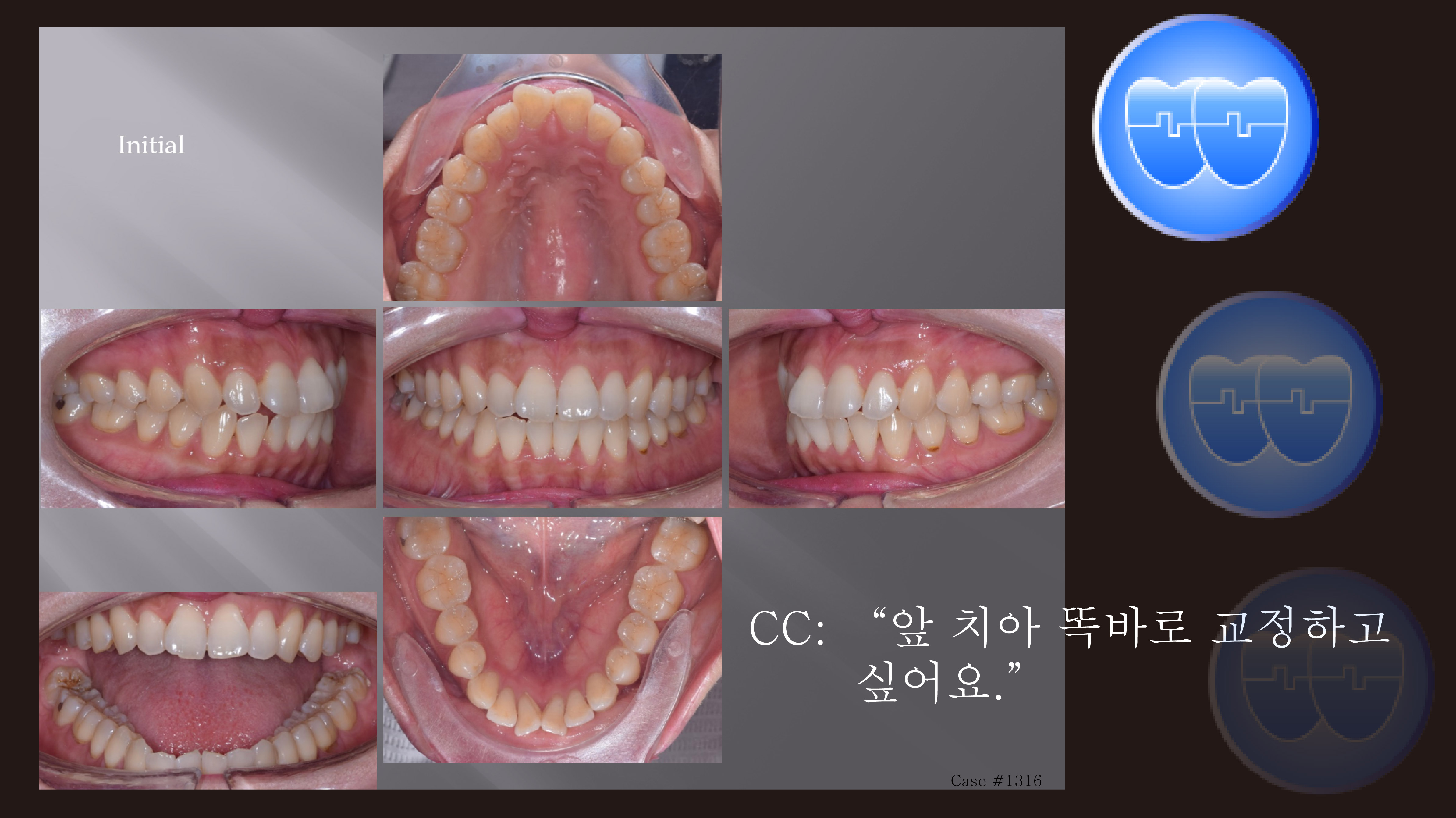 교정 Case 1316. 비발치, Rotated Anterior Teeth, Sem #3