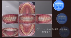 교정 Case 1316. 비발치, Rotated Anterior Teeth, Sem #3