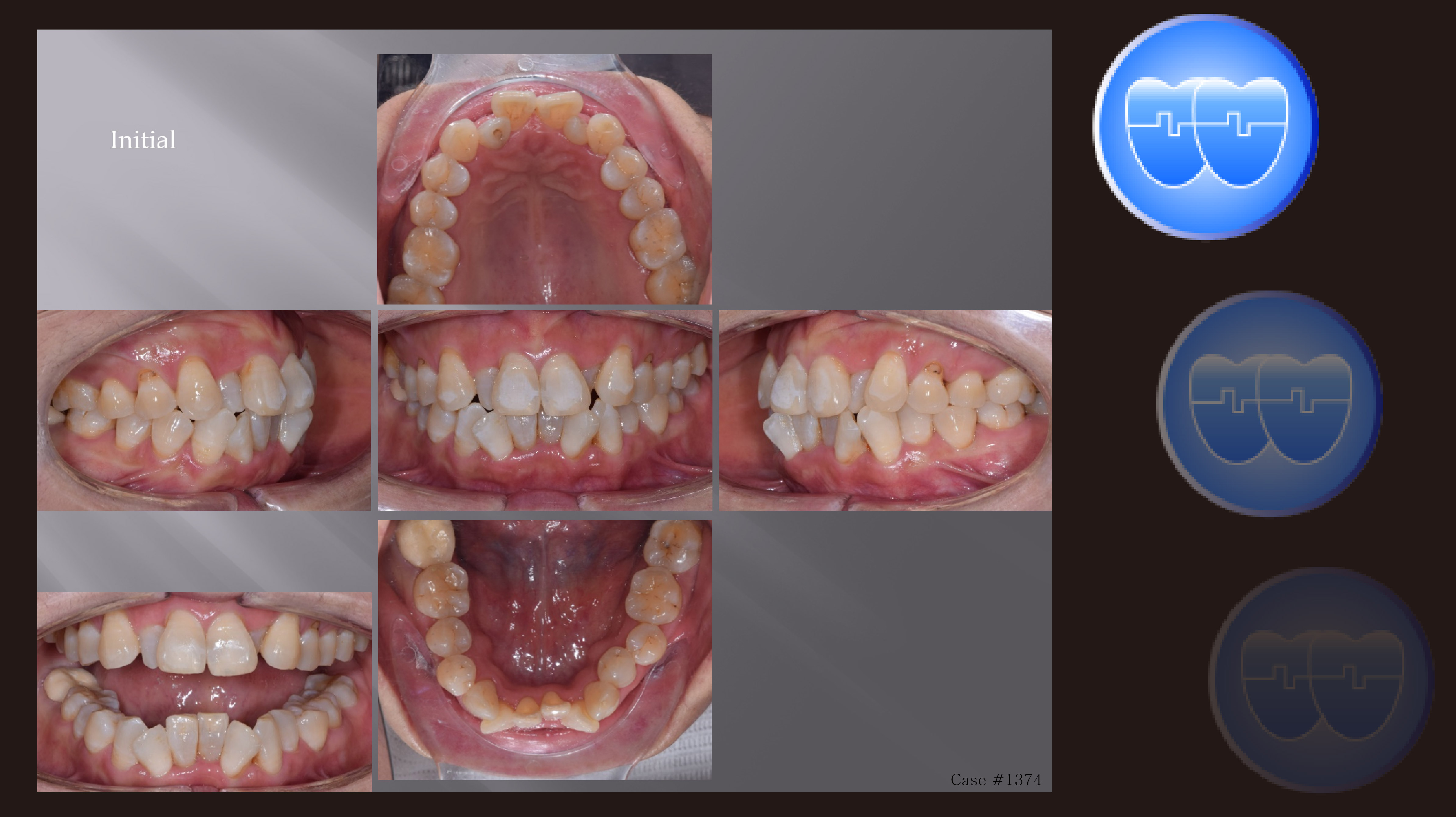 교정 Case 1374. L1 발치, 부분교정, Anterior Crossbite, Crowding, Sem #20.5