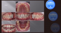 교정 Case 1374. L1 발치, 부분교정, Anterior Crossbite, Crowding, Sem #20.5