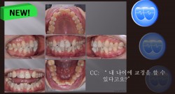 교정 Case 1374. L1 발치, 부분교정, Anterior Crossbite, Lower Crowding, Sem #20.5