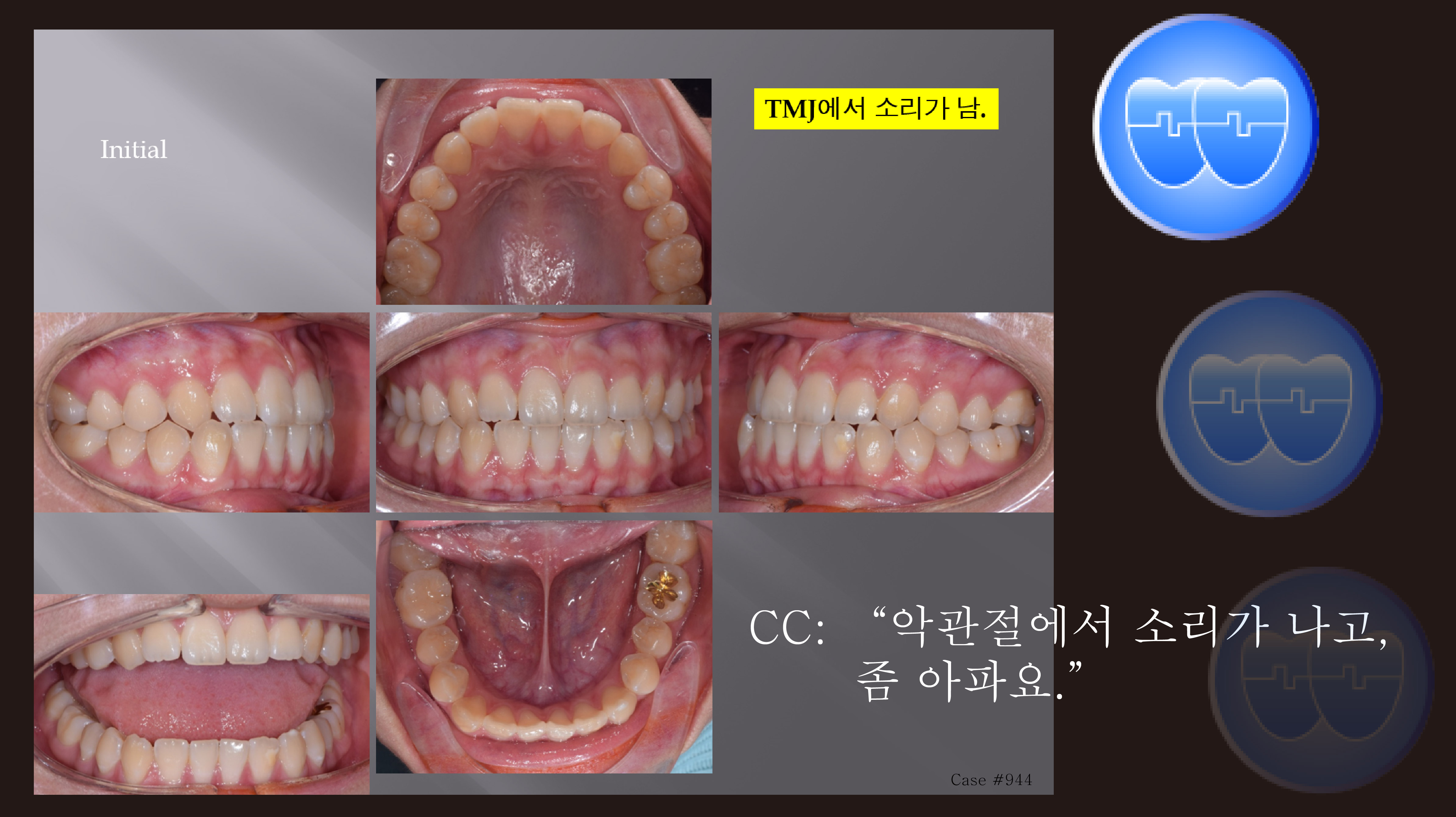 교정 Case 944. 비발치, TMJ Clicking, TMJ Pain, Anterior Crossbite, Sem #19