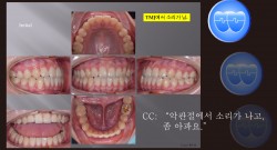 교정 Case 944. 비발치, TMJ Clicking, TMJ Pain, Anterior Crossbite, Sem #19