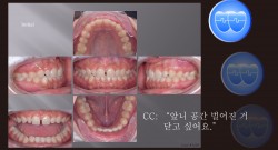 교정 Case 1398. 비발치, 부분교정, Upper Diastema, Sem #20.5