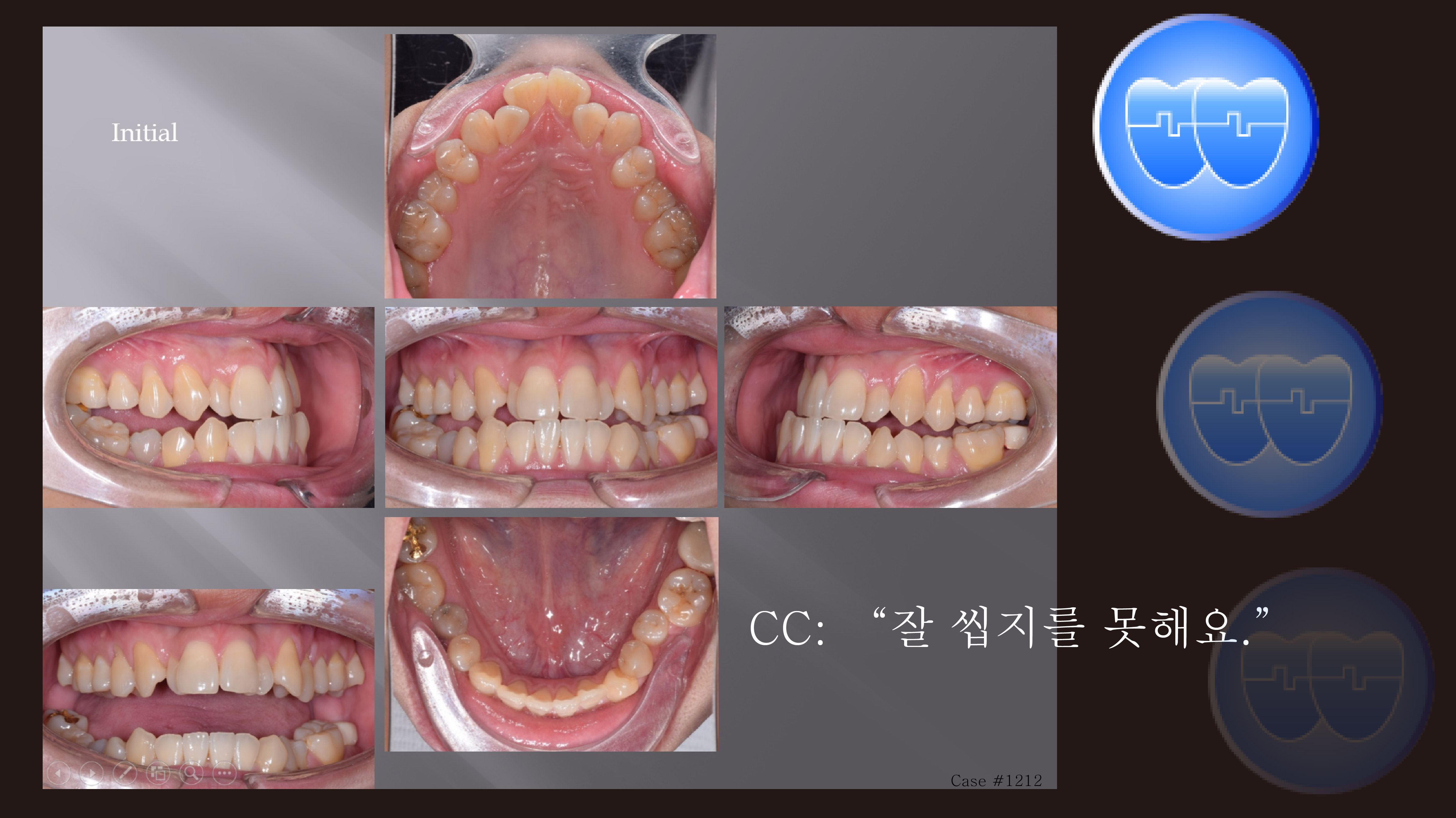 교정 Case 1212.  L5 발치, Lower Lingual Corticotomy, Severe Posterior Crossbite, Bonded RPE, Sem #7.8