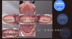 교정 Case 1212.  L5 발치, Lower Lingual Corticotomy, Severe Posterior Crossbite, Bonded RPE, Sem #7.8