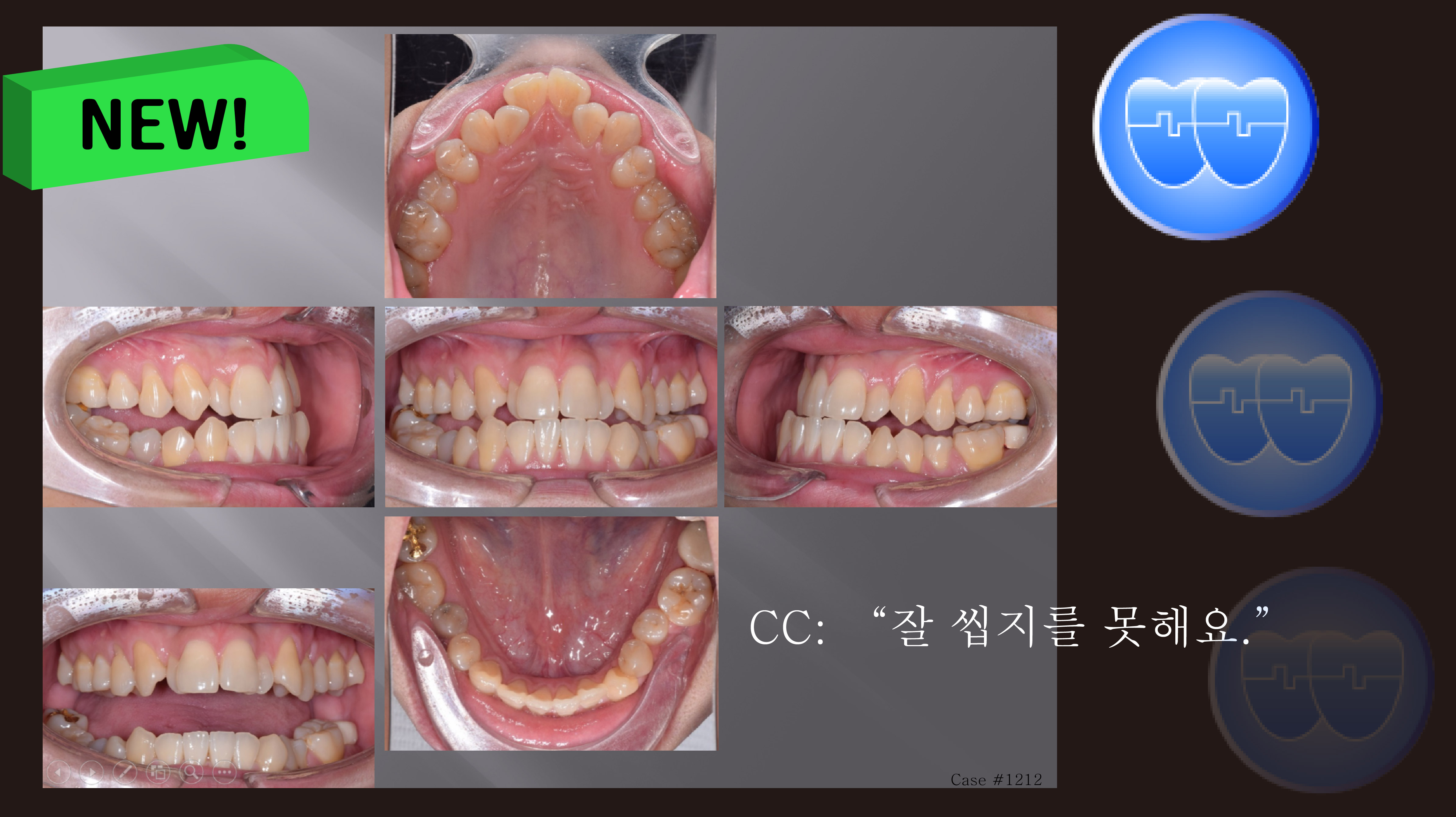 교정 Case 1212. L5 발치, Lower Lingual Corticotomy, Severe Posterior Crossbite, Bonded RPE, Sem #7.8