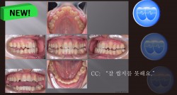 교정 Case 1212. L5 발치, Lower Lingual Corticotomy, Severe Posterior Crossbite, Bonded RPE, Sem #7.8