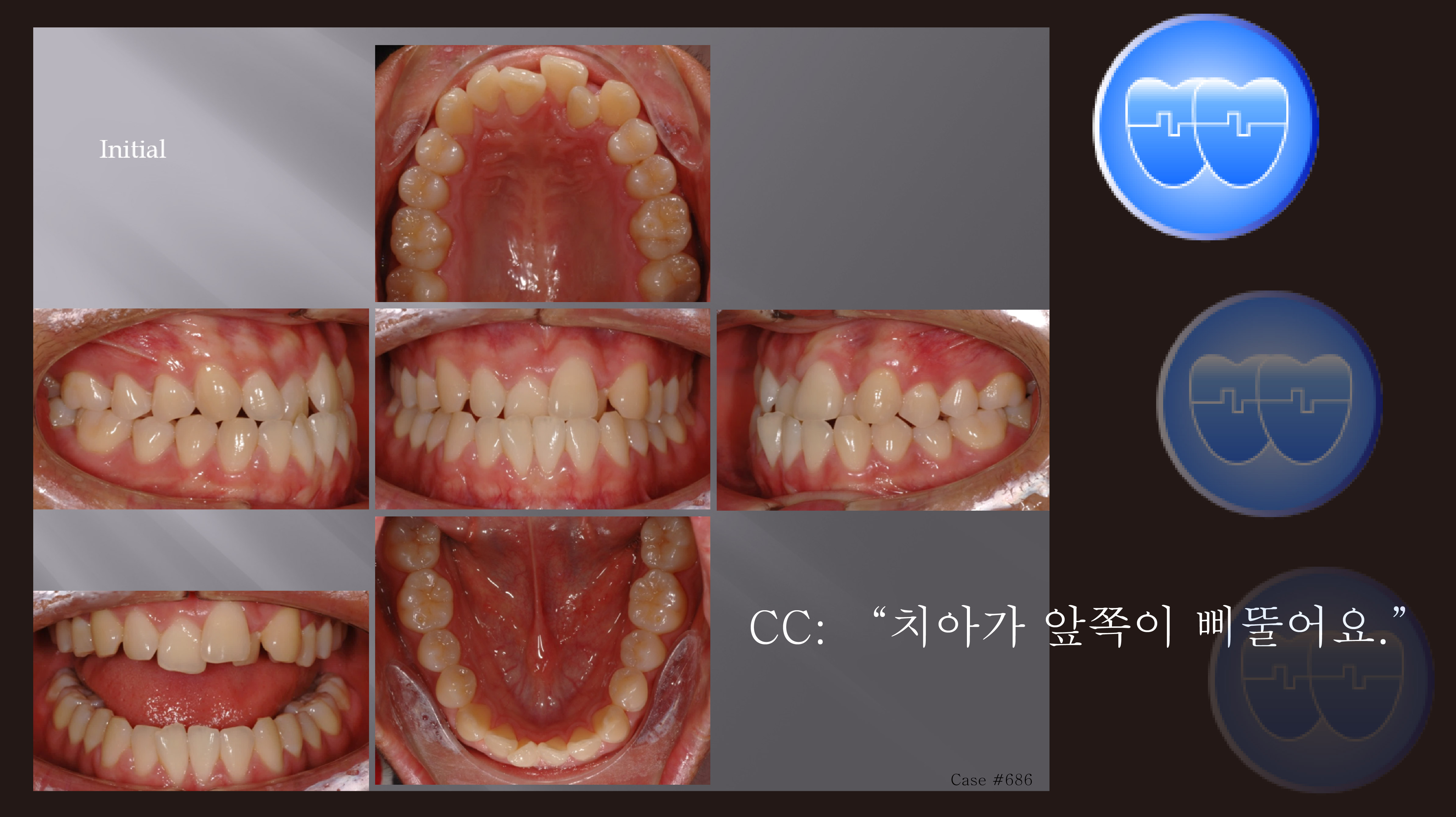 교정 Case 686. 비발치, Class III, Anterior Crossbite, 시갈 버튼, Sem #16