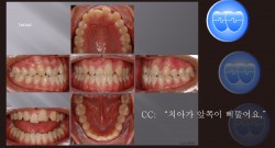 교정 Case 686. 비발치, Class III, Anterior Crossbite, 시갈 버튼, Sem #16