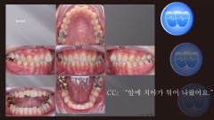 교정 Case 1300. 비발치, Rotated Anterior Teeth, Stripping, Sem #3