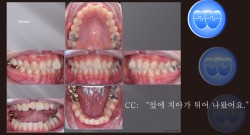 교정 Case 1300. 비발치, Rotated Anterior Teeth, Stripping, Sem #3