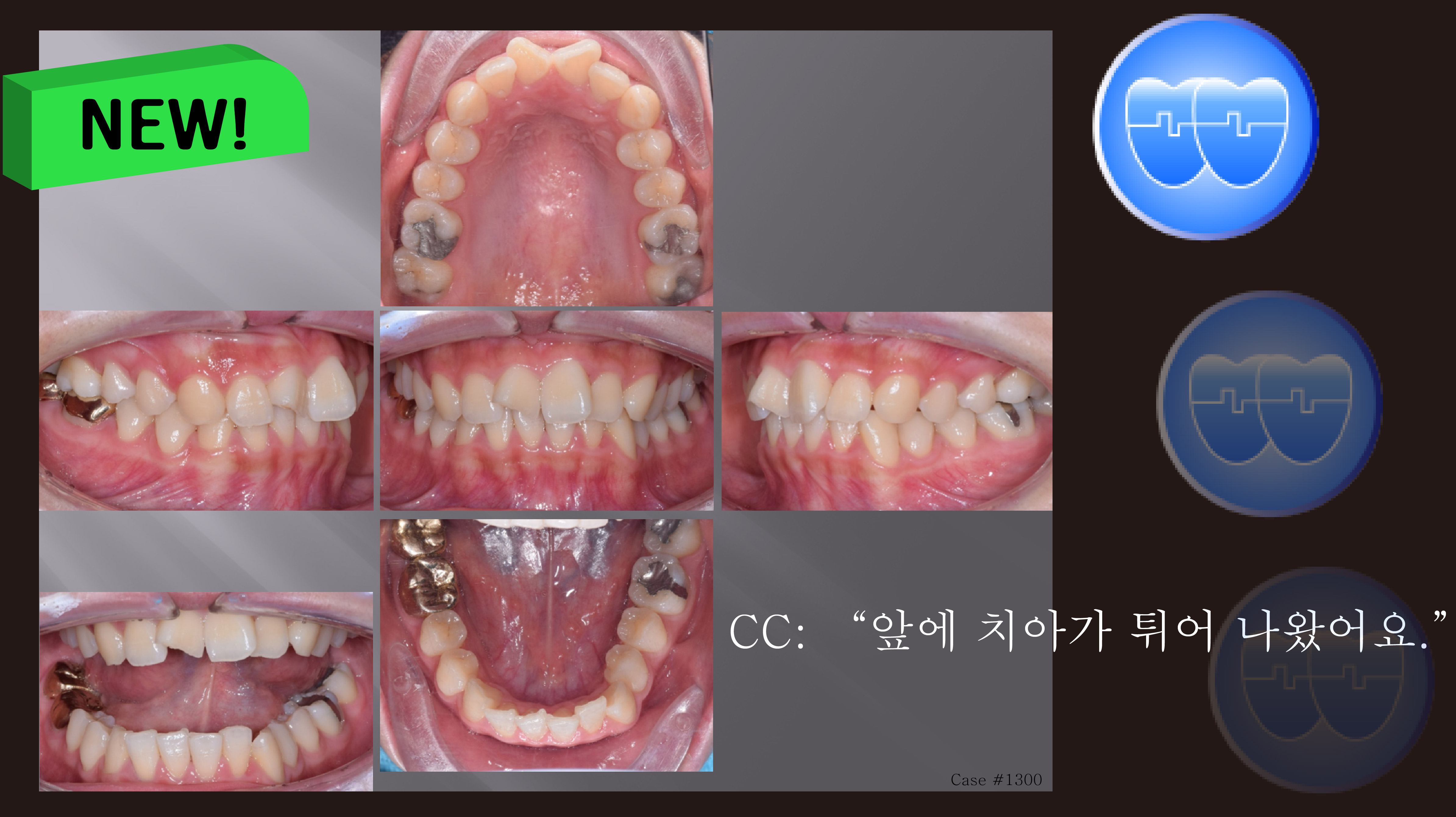 교정 Case 1300. 비발치, Rotated Anterior Teeth, Stripping, Sem #3