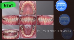 교정 Case 1300. 비발치, Rotated Anterior Teeth, Stripping, Sem #3