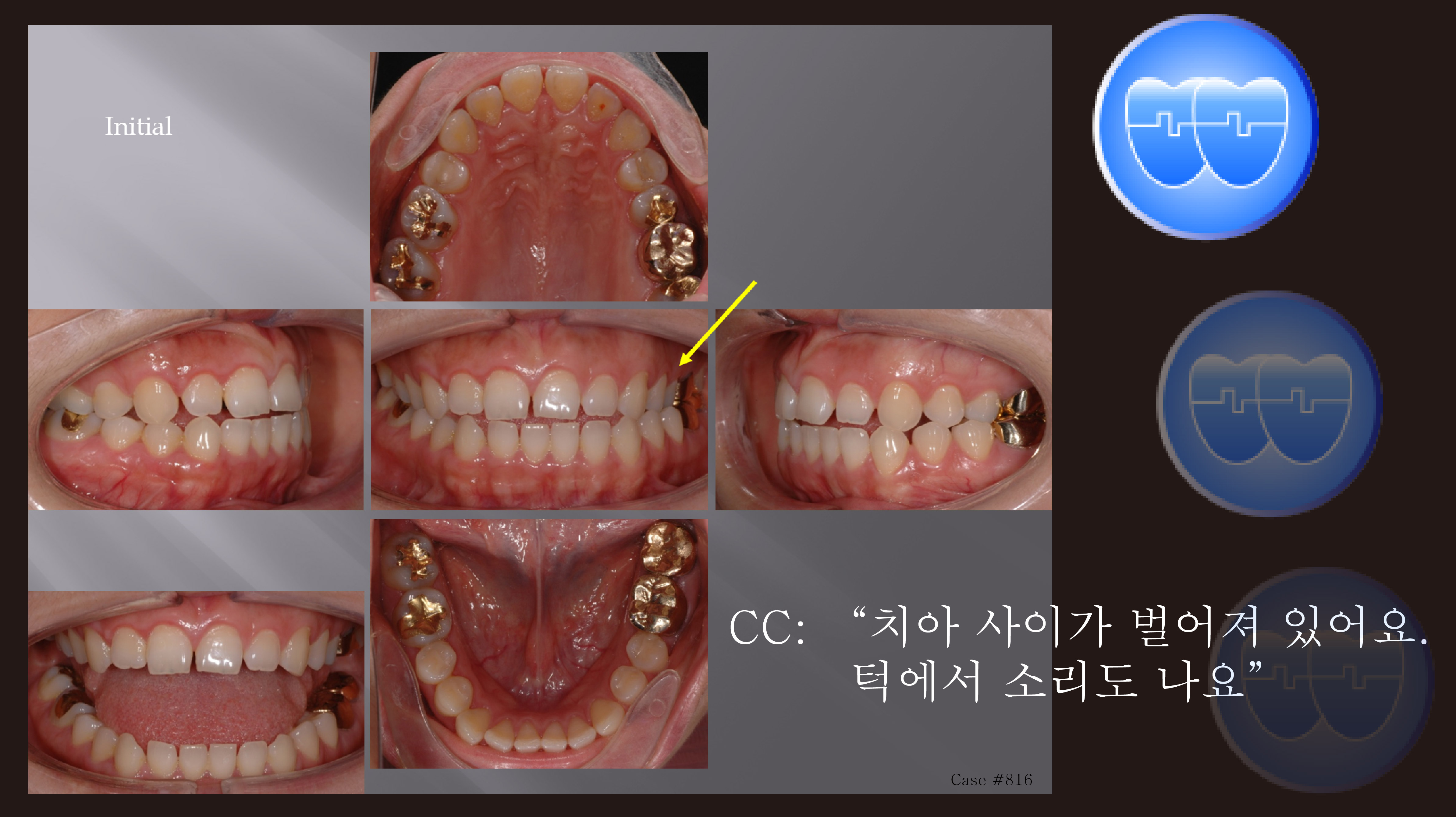 교정 Case 816. 비대칭 발치, TMJ 환자, Treatment Limitation,  Sem #19