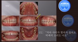 교정 Case 816. 비대칭 발치, TMJ 환자, Treatment Limitation,  Sem #19