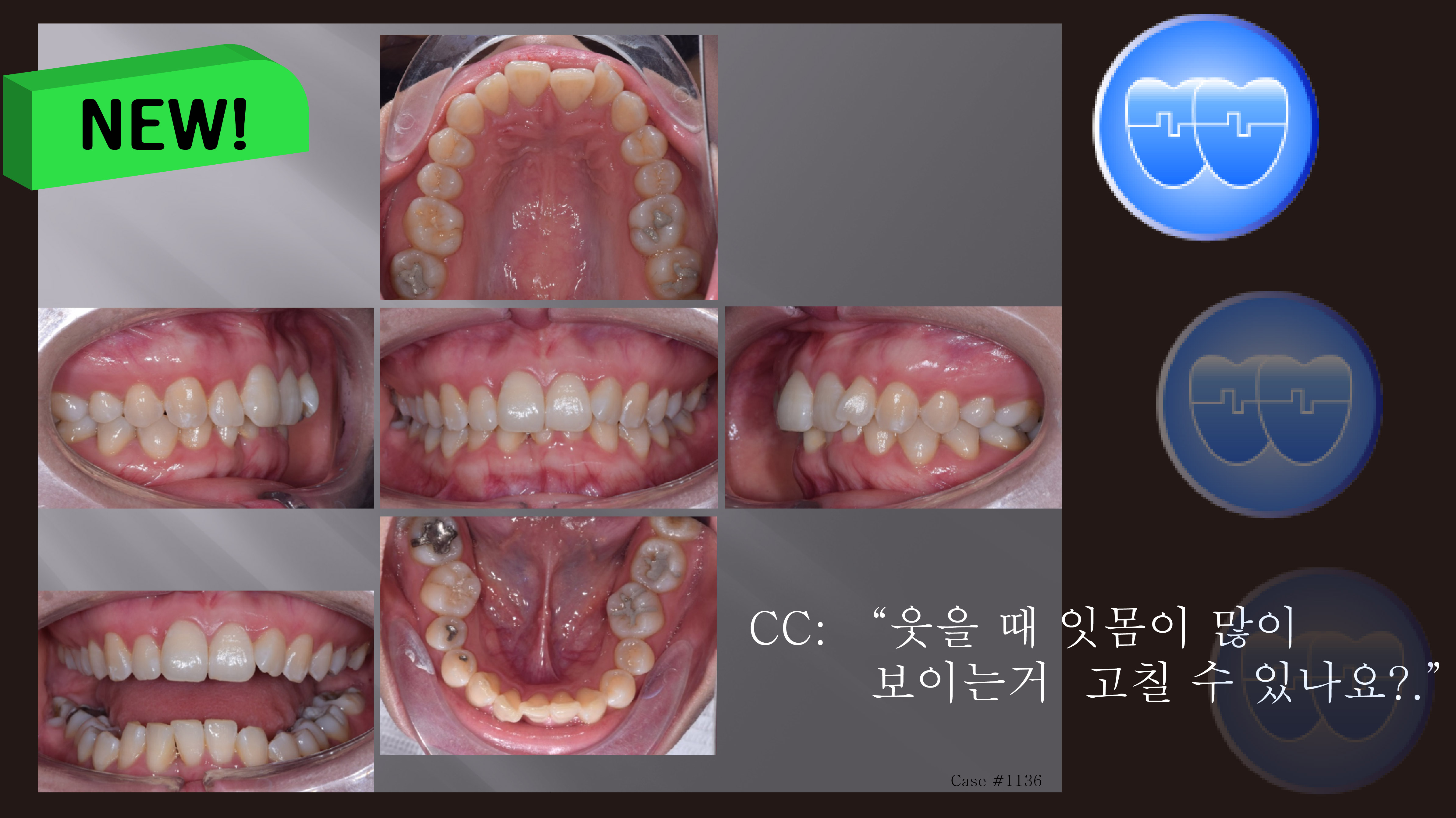 교정 Case 1136. U5L1 발치, Dental Deepbite, Gummy Smile, Sem #7.5