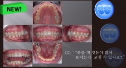 교정 Case 1136. U5L1 발치, Dental Deepbite, Gummy Smile, Sem #7.5