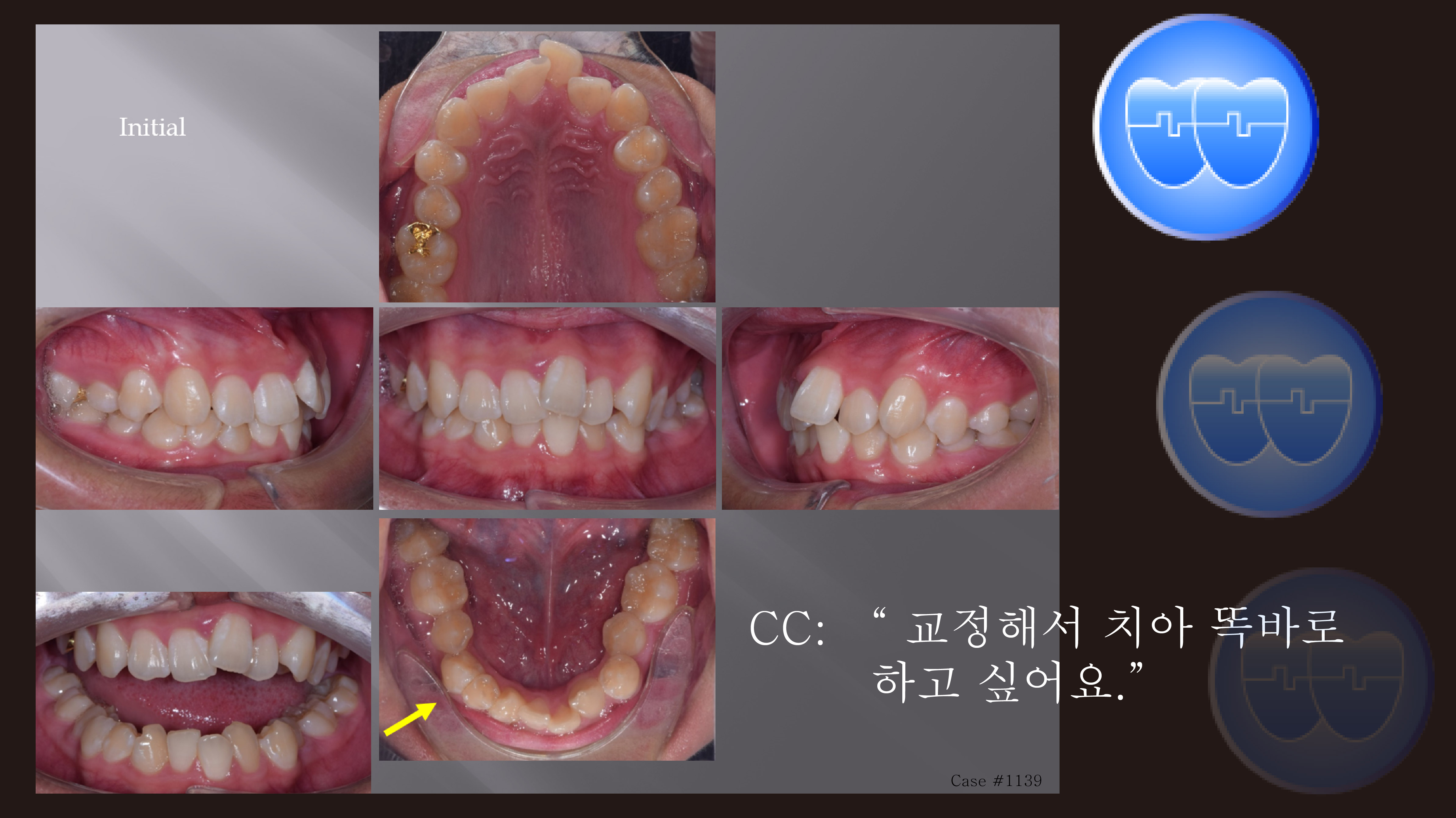 교정 Case 1139. Dental Deepbite, Geminated Teeth, Malformed Teeth, Congenital Missing Teeth, Sem #13.2