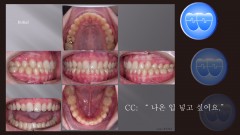 교정 Case 1324. U5L5 발치, Moderate Protrusion, Sem # 12.4