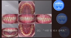 교정 Case 1324. U5L5 발치, Moderate Protrusion, Sem # 12.4