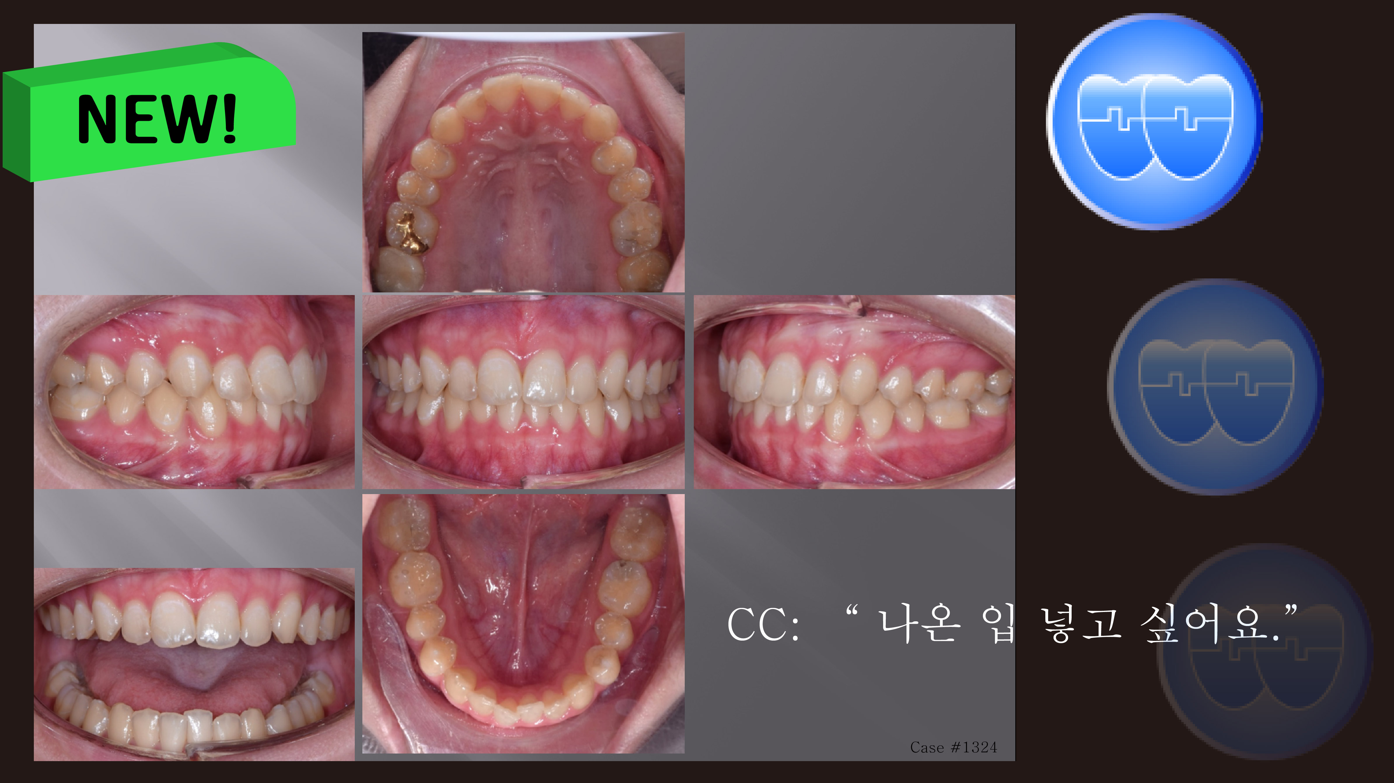 교정 Case 1324. U5L5 발치, Moderate Protrusion, Sem # 12.4