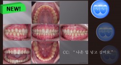 교정 Case 1324. U5L5 발치, Moderate Protrusion, Sem # 12.4