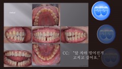 교정 Case 1373. 부분교정, Lower Anterior Teeth Space Closure, Sem #20.5