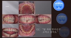 교정 Case 1373. 부분교정, Lower Anterior Teeth Space Closure, Sem #20.5