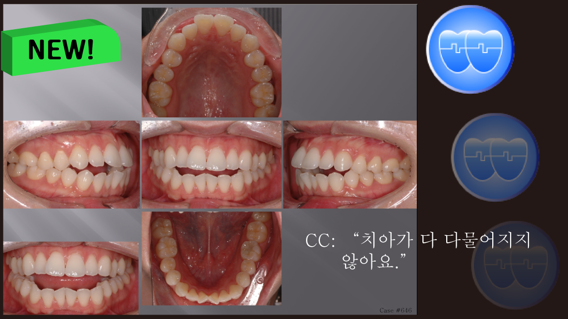 교정 Case 646. U5L5 발치, Dental Openbite, Protrusion, Sem #7