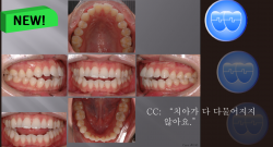 교정 Case 646. U5L5 발치, Dental Openbite, Protrusion, Sem #7