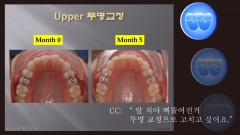 교정 Case 454. 투명교정 Upper Only, Sem #23