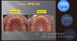 교정 Case 454. 투명교정 Upper Only, Sem #23