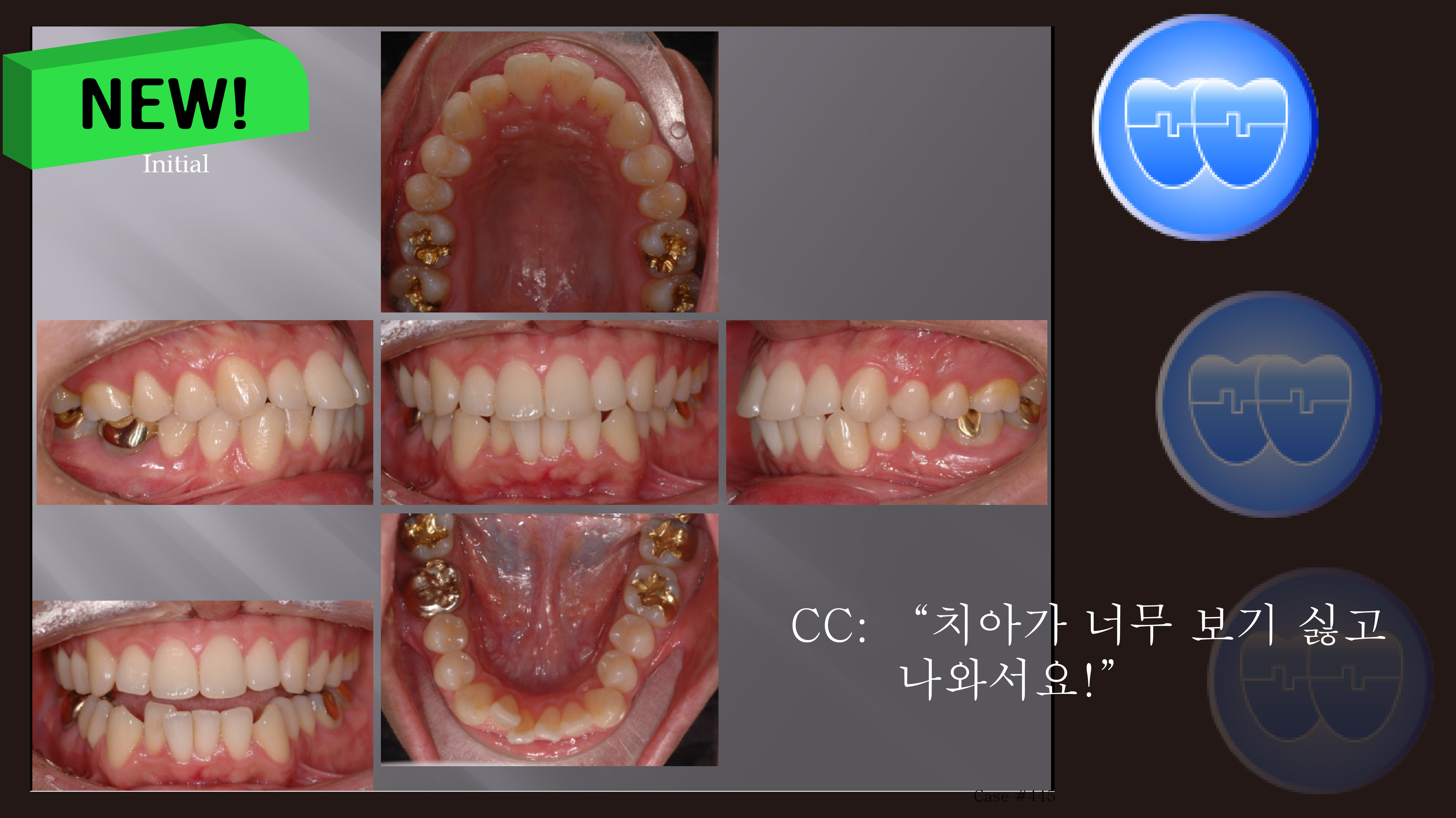 교정 Case 445. U4L4 발치, Protrusion, Skeletal Class I, 성인, Sem #10