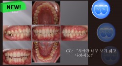 교정 Case 445. U4L4 발치, Protrusion, Skeletal Class I, 성인, Sem #10