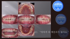 교정 Case 1261. U5 발치, 실수한 Case, Dental Openbite, Power Chain의 부작용, Sem #12.6