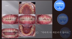 교정 Case 1261. U5 발치, 실수한 Case, Dental Openbite, Power Chain의 부작용, Sem #12.6