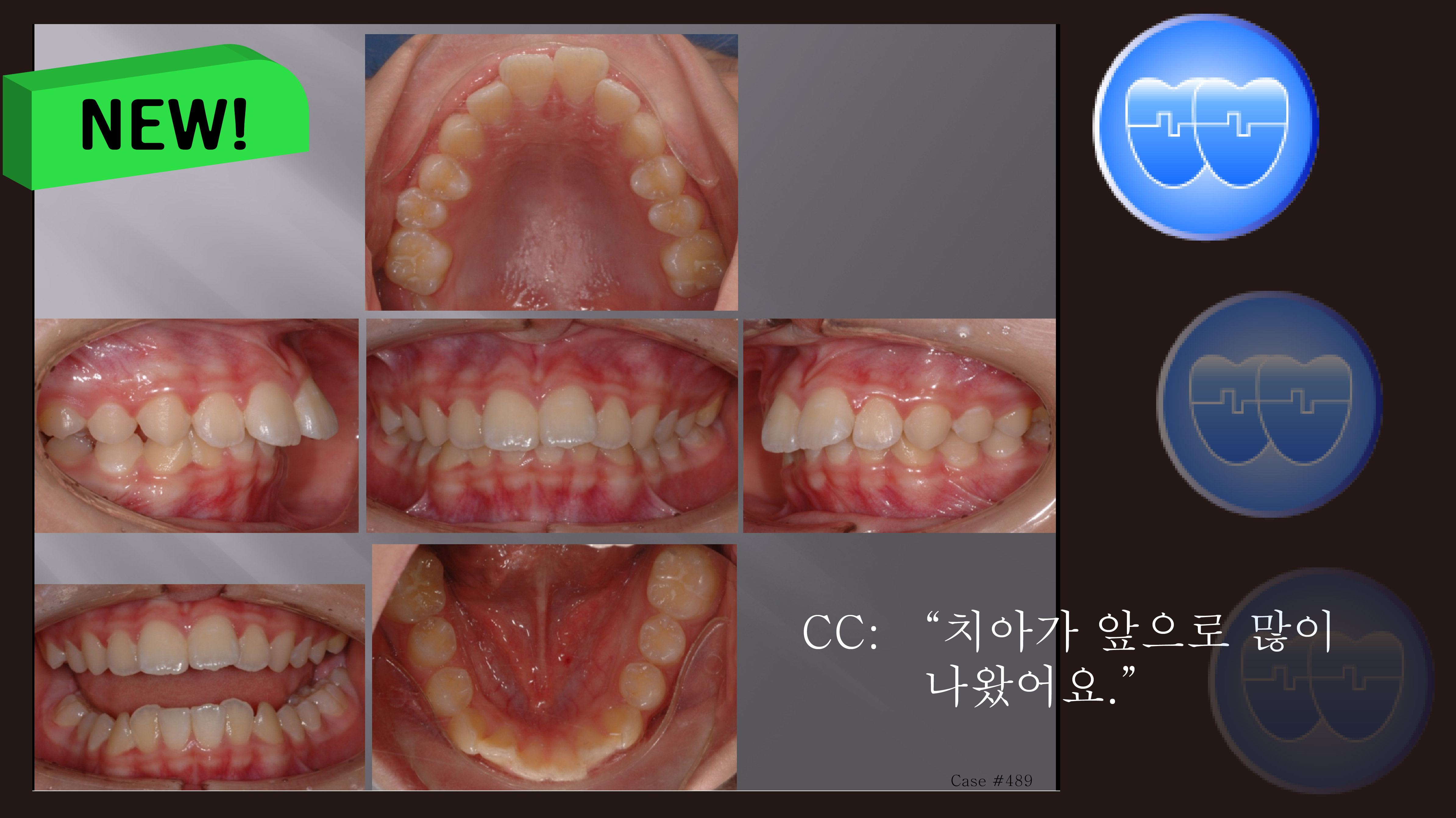 교정 Case 489. U4 발치, Severe Class II, Early DBS & Root Formation, Sem #12.5