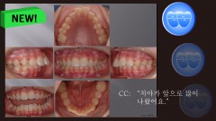 교정 Case 489. U4 발치, Severe Class II, Early DBS & Root Formation, Sem #12.5