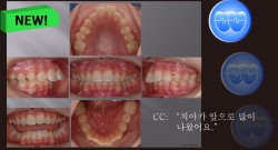 교정 Case 489. U4 발치, Severe Class II, Early DBS & Root Formation, Sem #12.5