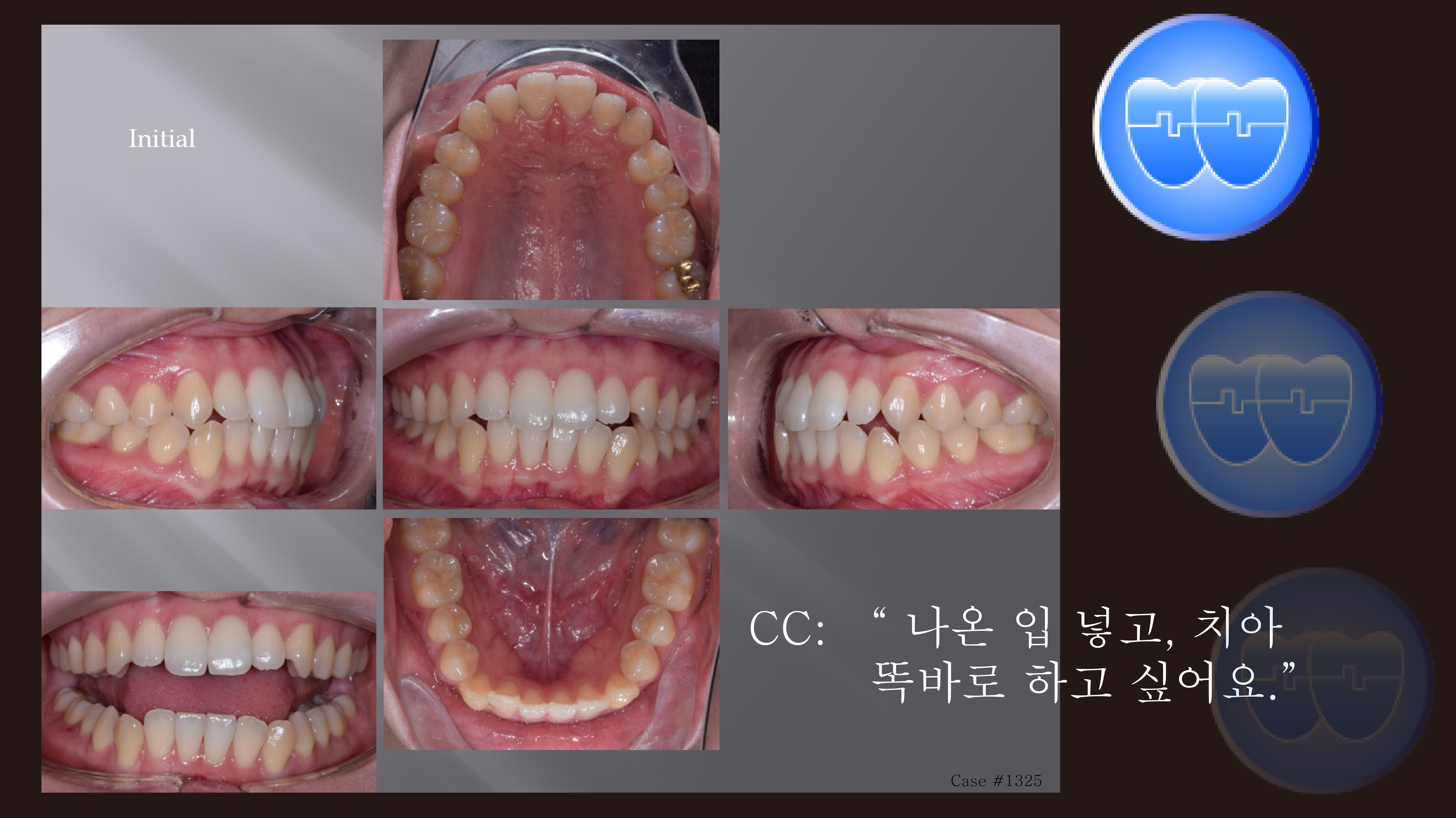 교정 Case 1325. U5L4 발치, 비대칭 Condylar Head, Protrusion, Sem #12.3