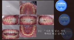 교정 Case 1325. U5L4 발치, 비대칭 Condylar Head, Protrusion, Sem #12.3