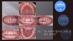 교정 Case 1079. 비발치, Openbite, Bilateral Posterior Crossbite, Bonded RPE, Midline을 위한 교합조정, Sem #7.8