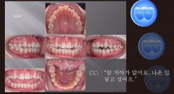 교정 Case 1079. 비발치, Openbite, Bilateral Posterior Crossbite, Bonded RPE, Midline을 위한 교합조정, Sem #7.8