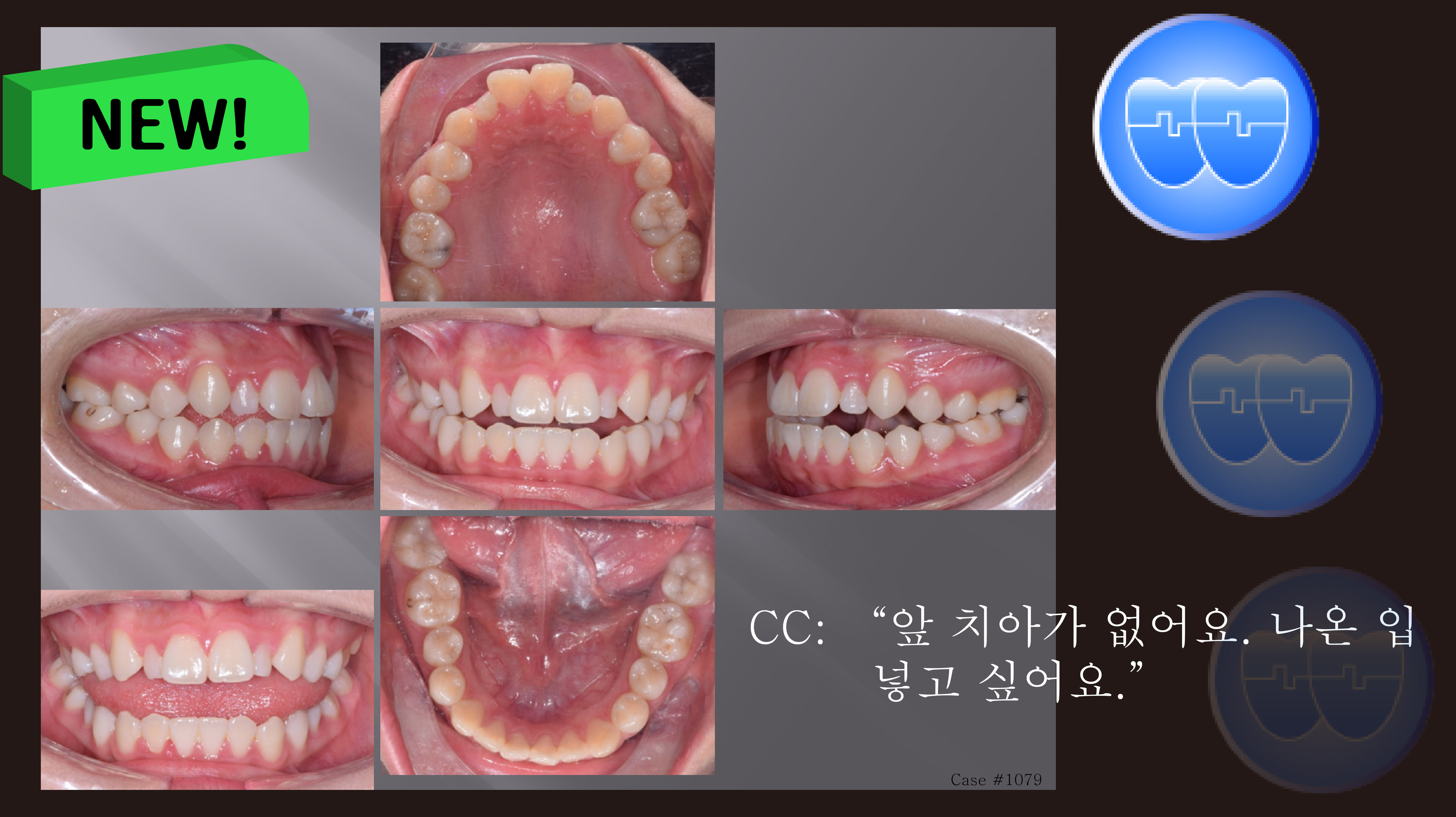 교정 Case 1079. 비발치, Openbite, Bilateral Posterior Crossbite, Bonded RPE, Midline을 위한 교합조정, Sem #7.8