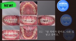 교정 Case 1079. 비발치, Openbite, Bilateral Posterior Crossbite, Bonded RPE, Midline을 위한 교합조정, Sem #7.8