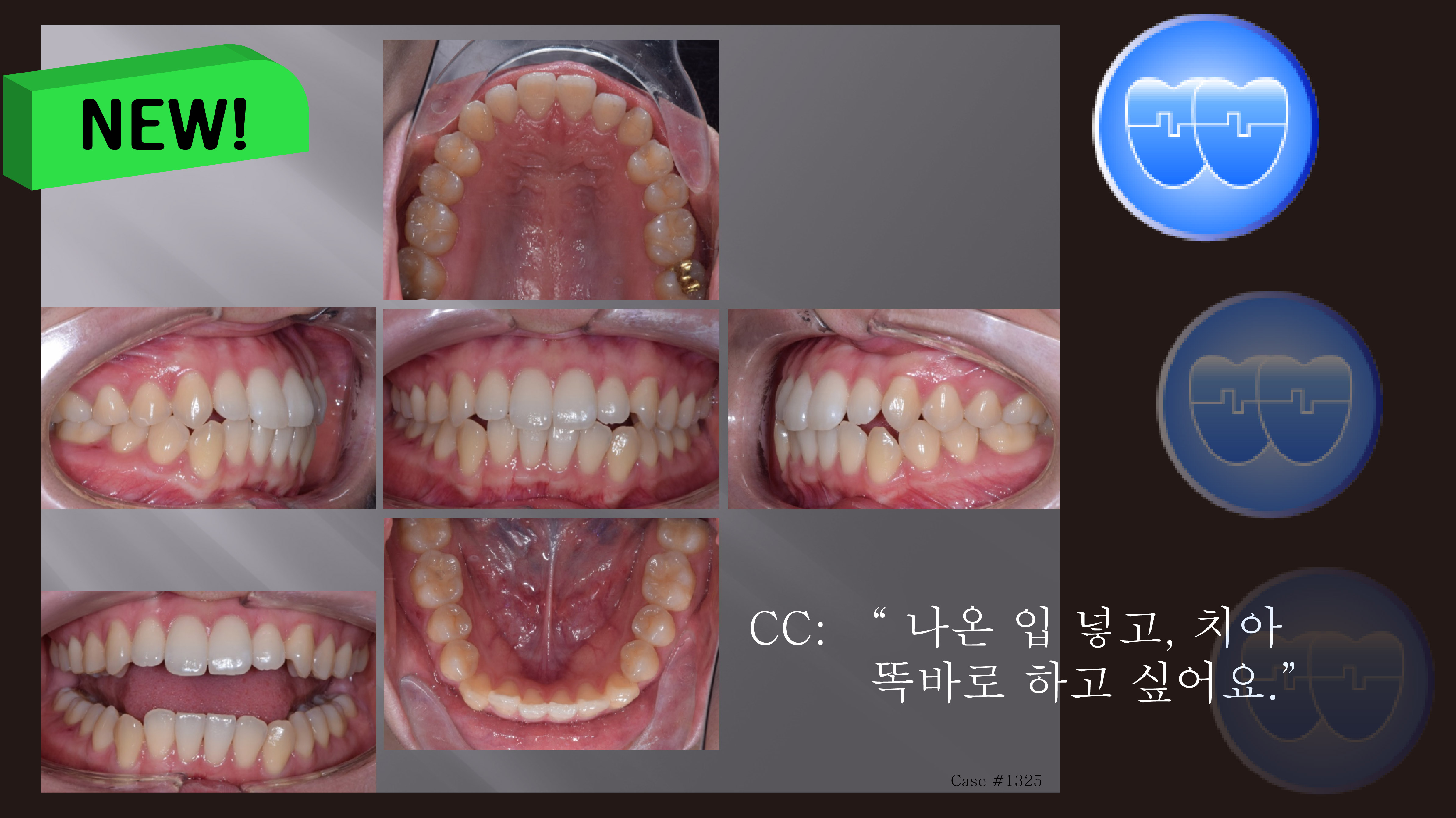 교정 Case 1325. U5L4 발치, 비대칭 Condylar Head, Protrusion, Sem #12.3